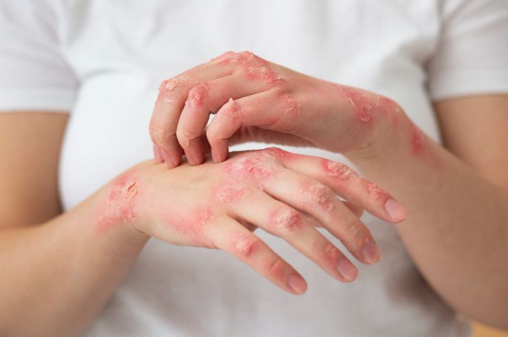 Skin disorders
